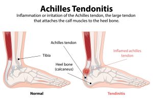 Achilles' heel是什么