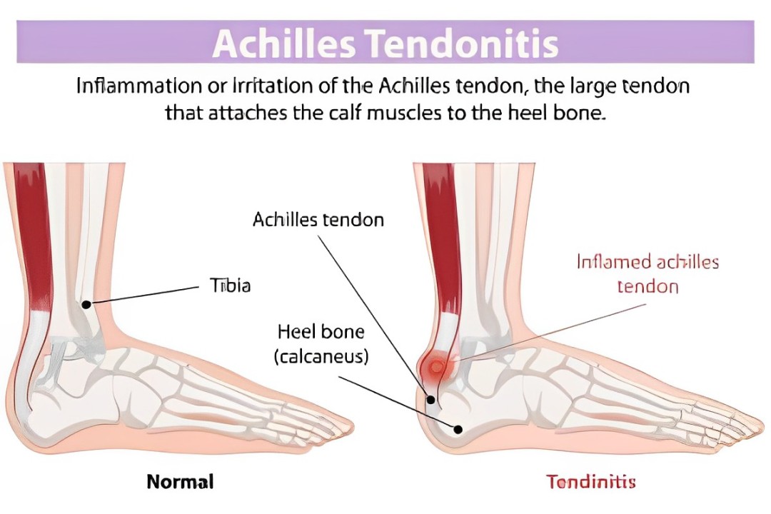 Achilles' heel是什么